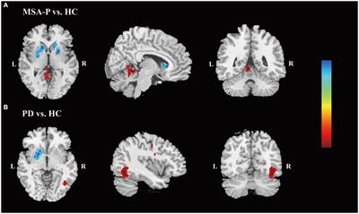Comparison of spontaneous brain activity in distinguishing parkinsonian variant of multiple system atrophy from Parkinson’s disease at an early stage